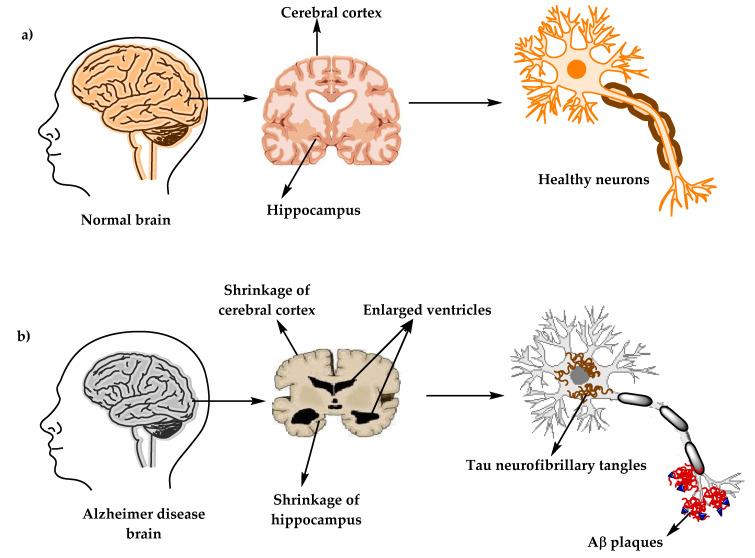 Structure of brains and neurons of a healthy brain in comparison with an Alzheimer's disease brain.